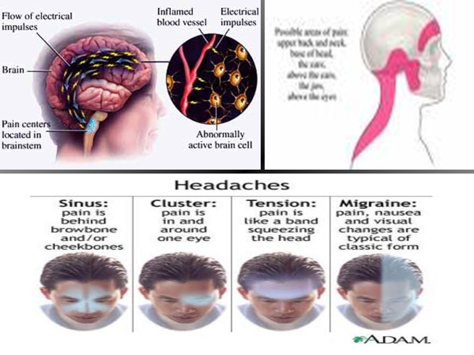 Headaches By Gabie Gomez Why Does My Head Hurt Headaches Are A Neurological Complaint That Can Be Insignificant Or Prodromal The Exact Mechanism Ppt Download Headaches By Gabie Gomez Why Does My Head Hurt Headaches Are A Neurological Complaint That Can Be Insignificant Or Prodromal The Exact Mechanism Ppt Download