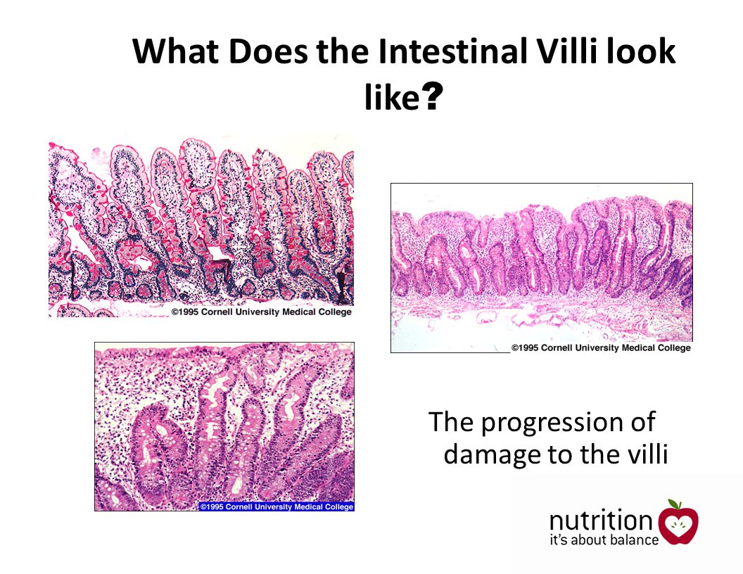 What Does the Intestinal Villi look like The progression of damage to the villi