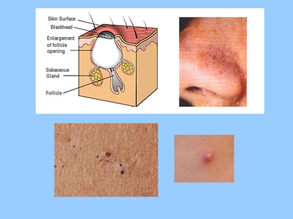 Hair Hair Follicles A Follicle Is A Deep Pit Where Hair Grows