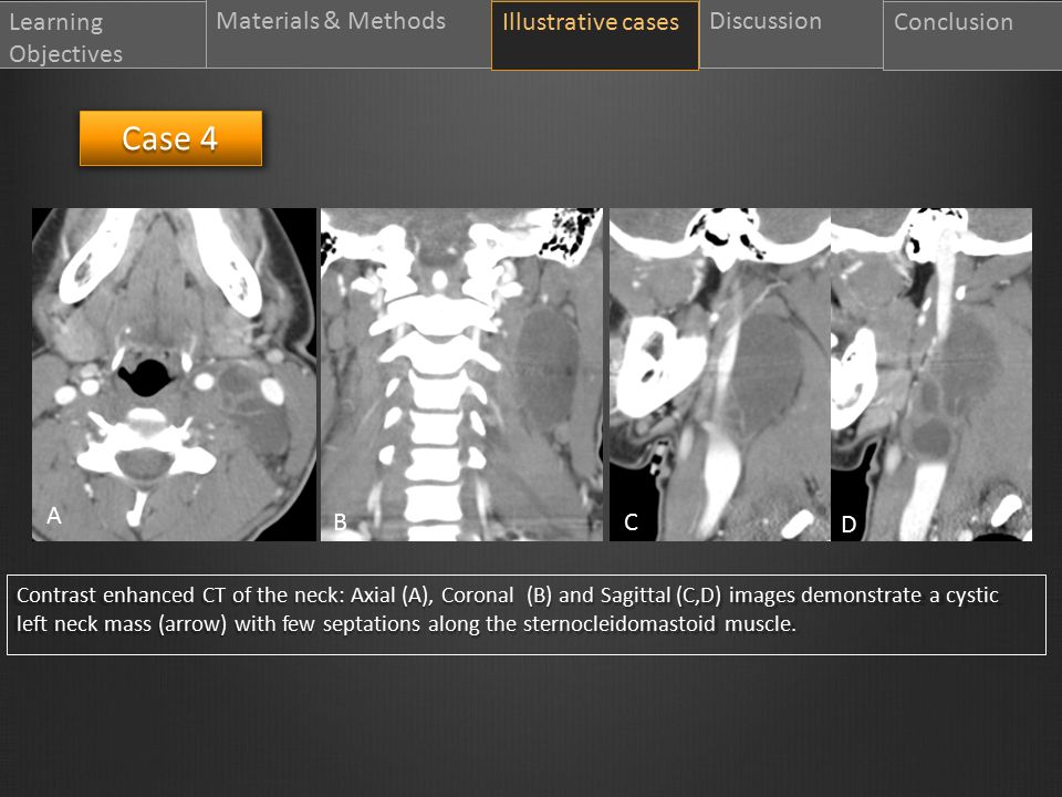 Learning Objectives Materials & MethodsIllustrative casesDiscussion Conclusion Case 4 Illustrative cases Contrast enhanced CT of the neck: Axial (A), Coronal (B) and Sagittal (C,D) images demonstrate a cystic left neck mass (arrow) with few septations along the sternocleidomastoid muscle.