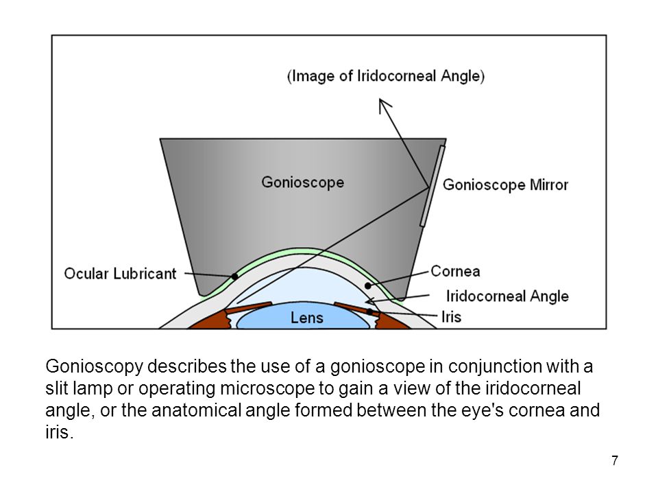 7 Gonioscopy describes the use of a gonioscope in conjunction with a slit lamp or operating microscope to gain a view of the iridocorneal angle, or the anatomical angle formed between the eye s cornea and iris.