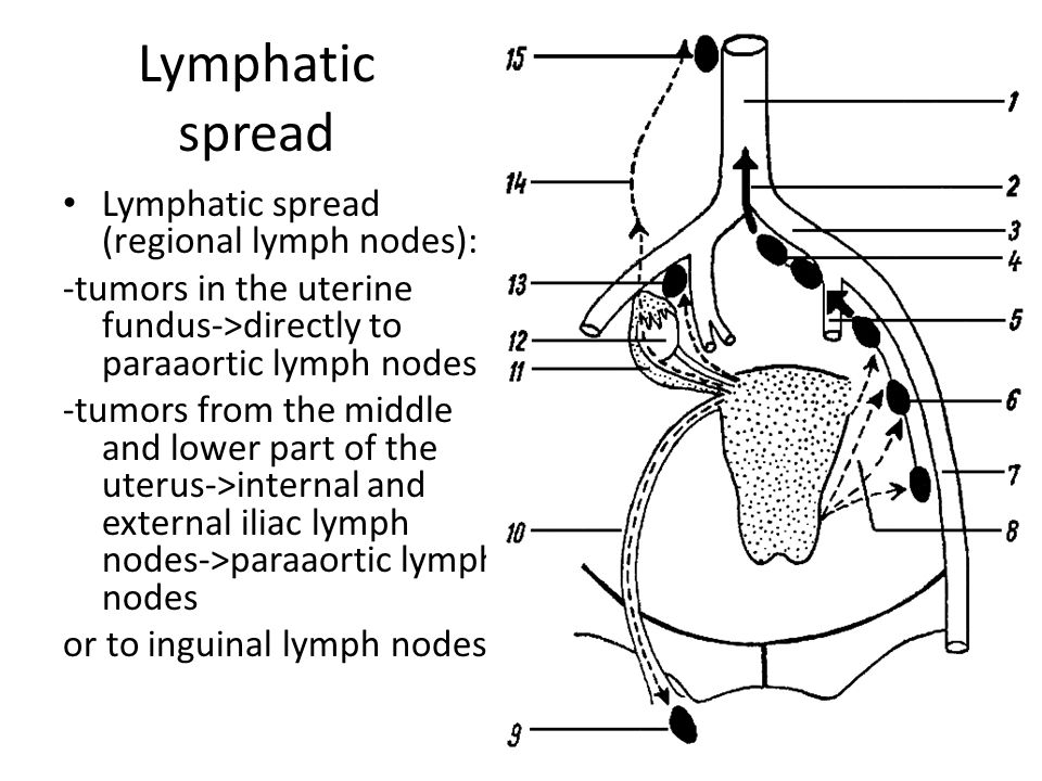 Endometrial cancer lymphatic spread. Endometrial cancer lymphatic spread - rafinament-club.ro