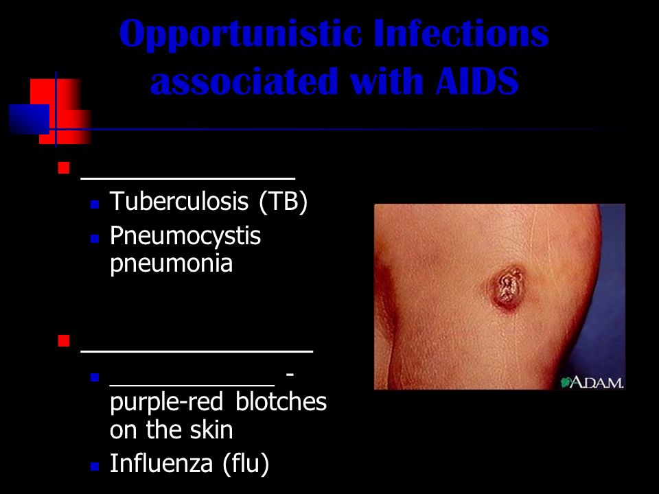 Opportunistic Infections associated with AIDS ____________ Tuberculosis (TB) Pneumocystis pneumonia _____________ ____________ - purple-red blotches on the skin Influenza (flu)