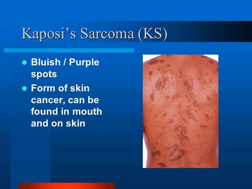 Kaposi’s Sarcoma (KS) Bluish / Purple spots Form of skin cancer, can be found in mouth and on skin