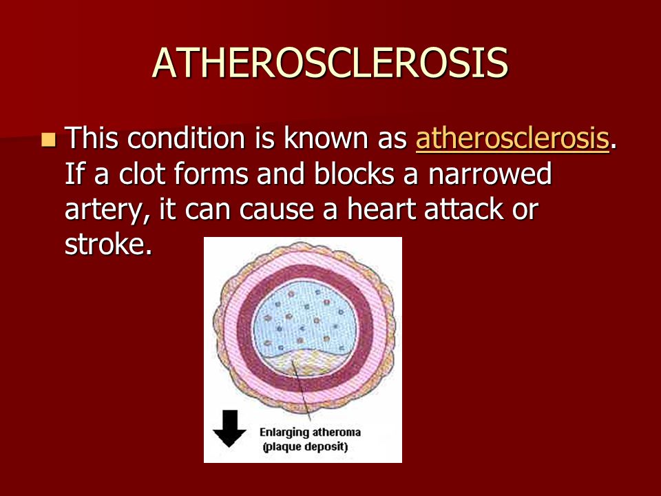 ATHEROSCLEROSIS This condition is known as atherosclerosis.
