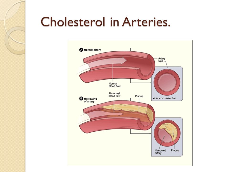 Cholesterol in Arteries.