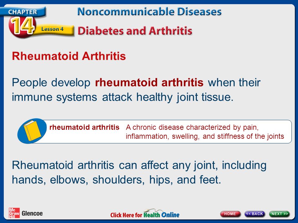 Rheumatoid Arthritis People develop rheumatoid arthritis when their immune systems attack healthy joint tissue.