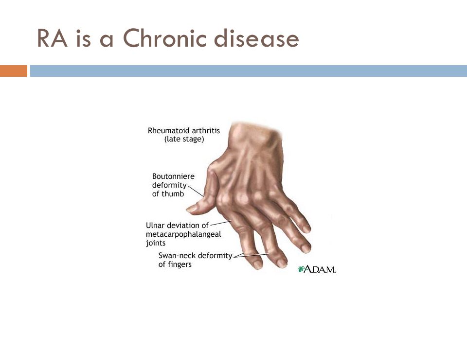 RA is a Chronic disease
