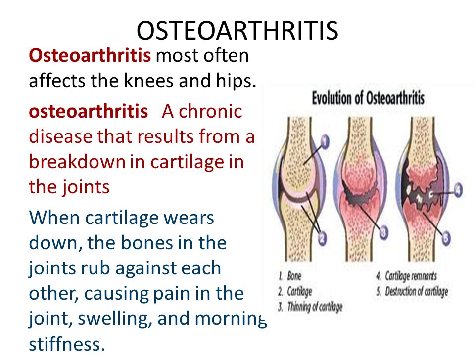 OSTEOARTHRITIS Osteoarthritis most often affects the knees and hips.