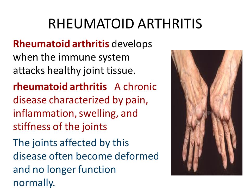 RHEUMATOID ARTHRITIS Rheumatoid arthritis develops when the immune system attacks healthy joint tissue.