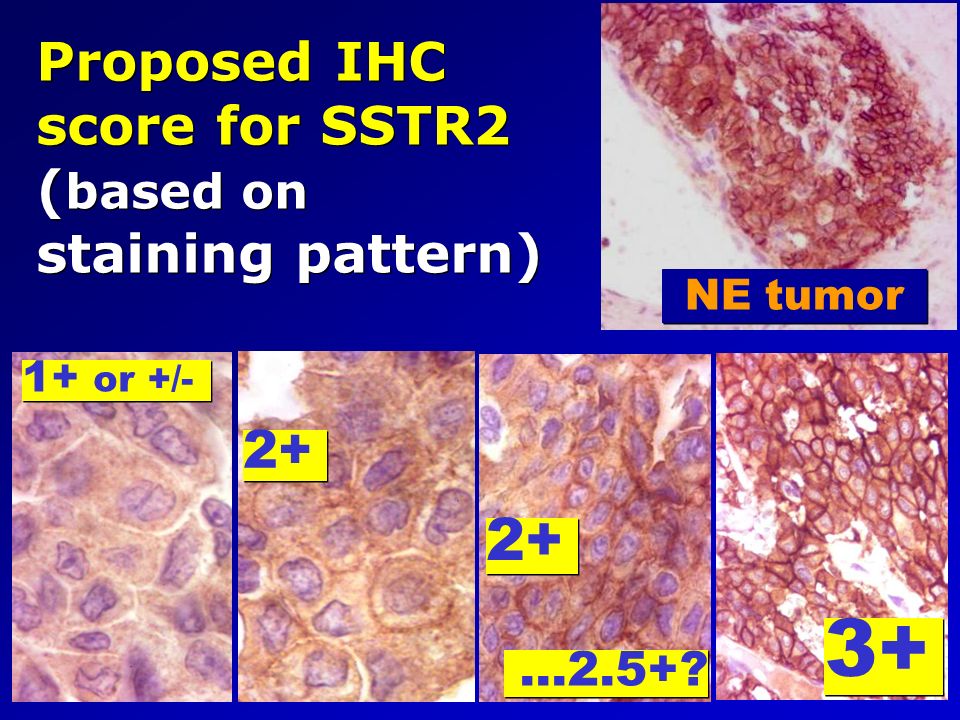 Proposed IHC score for SSTR2 ( based on staining pattern) Case 2187A/2187B NE tumor …2.5+.