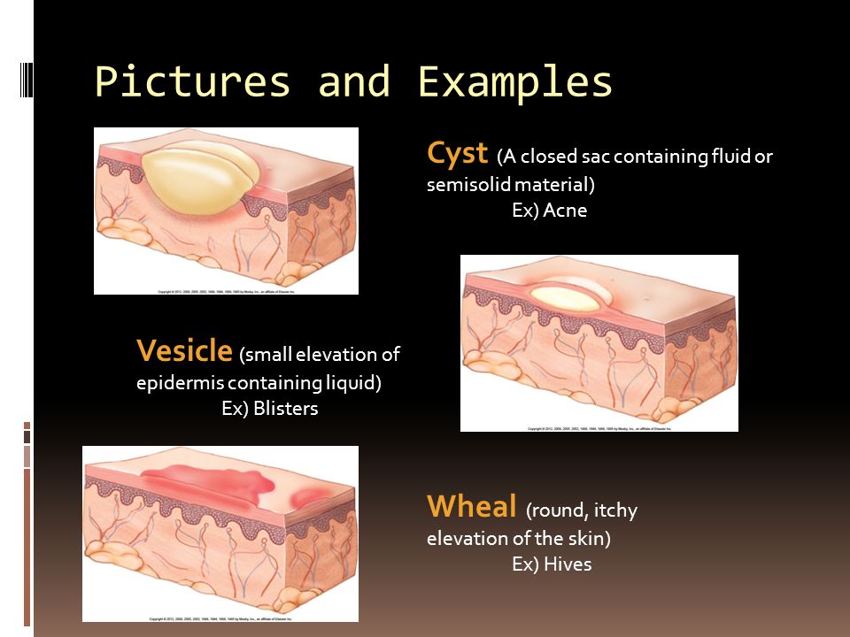 Pictures and Examples Cyst (A closed sac containing fluid or semisolid material) Ex) Acne Vesicle (small elevation of epidermis containing liquid) Ex) Blisters Wheal (round, itchy elevation of the skin) Ex) Hives