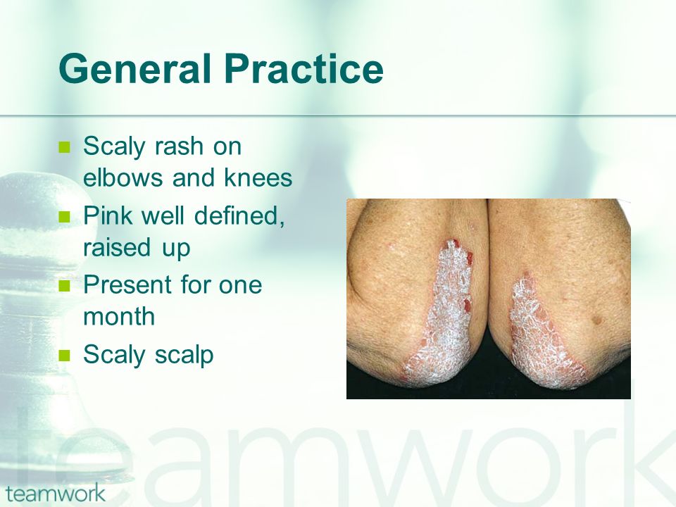 General Practice Scaly rash on elbows and knees Pink well defined, raised up Present for one month Scaly scalp