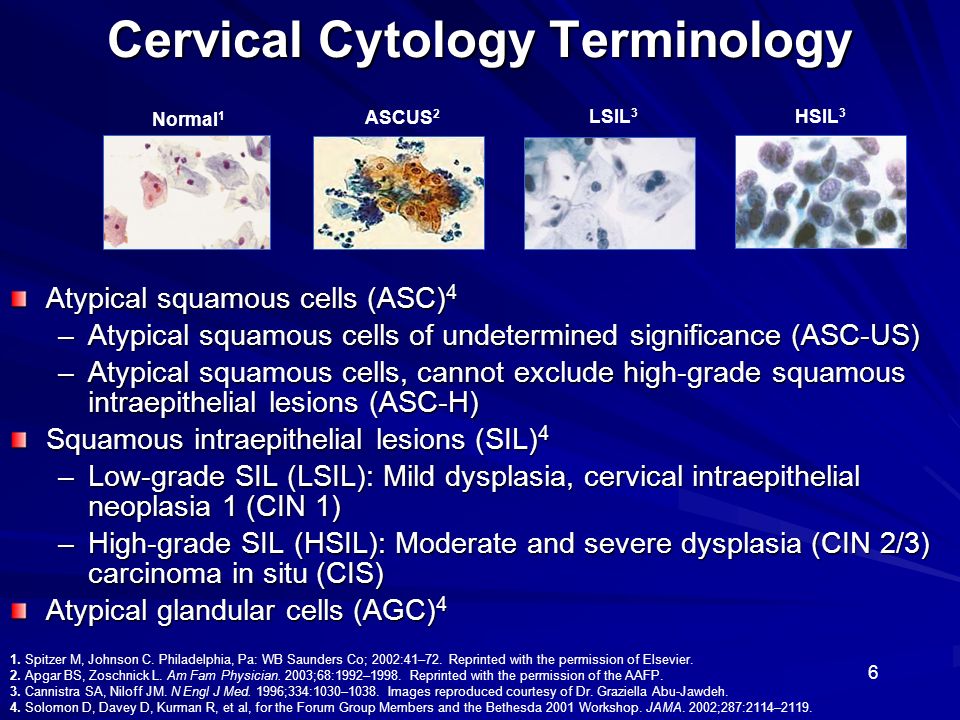 6 Cervical Cytology Terminology Atypical squamous cells (ASC) 4 –Atypical squamous cells of undetermined significance (ASC-US) –Atypical squamous cells, cannot exclude high-grade squamous intraepithelial lesions (ASC-H) Squamous intraepithelial lesions (SIL) 4 –Low-grade SIL (LSIL): Mild dysplasia, cervical intraepithelial neoplasia 1 (CIN 1) –High-grade SIL (HSIL): Moderate and severe dysplasia (CIN 2/3) carcinoma in situ (CIS) Atypical glandular cells (AGC) 4 1.