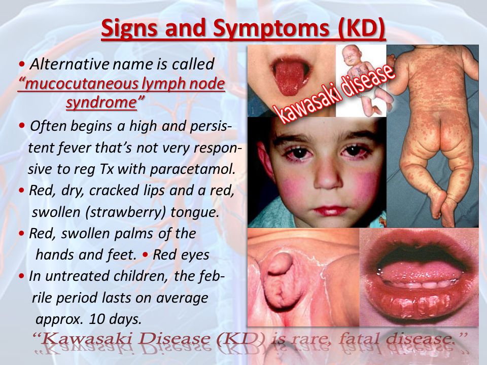 What is Kawasaki Disease? Kawasaki Disease (KD) also known as Kawasaki  Syndrome. An unusual and serious illness of young children. It is an  autoimmune. - ppt download