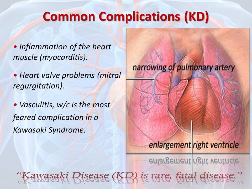 What is Disease? Kawasaki Disease (KD) also known Syndrome. An unusual and serious illness of young children. It is an autoimmune. - ppt download