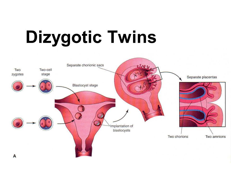 Dizygotic Twins