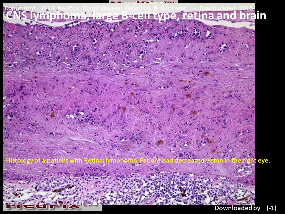 CNS lymphoma, large B-cell type, retina and brain Histology of a patient with Retinal lymphoma.