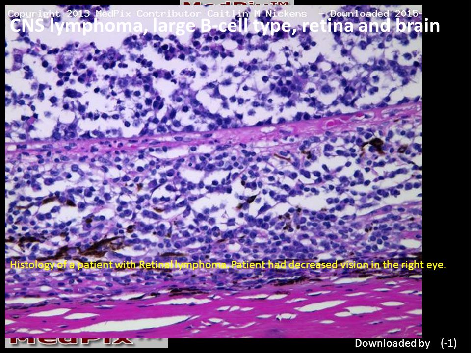 CNS lymphoma, large B-cell type, retina and brain Histology of a patient with Retinal lymphoma.