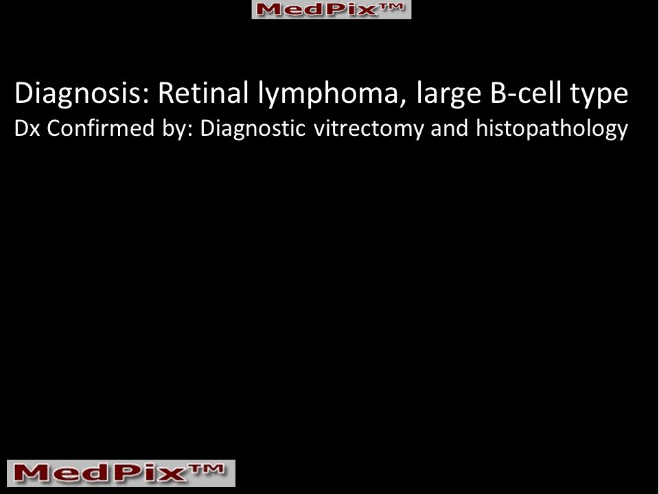 Diagnosis: Retinal lymphoma, large B-cell type Dx Confirmed by: Diagnostic vitrectomy and histopathology