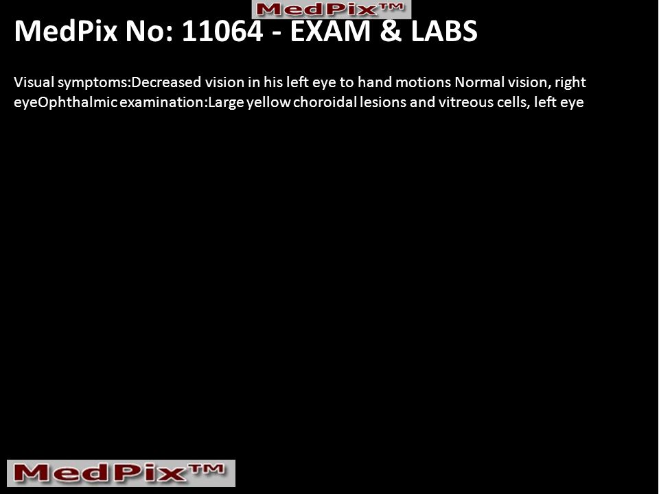 MedPix No: EXAM & LABS Visual symptoms:Decreased vision in his left eye to hand motions Normal vision, right eyeOphthalmic examination:Large yellow choroidal lesions and vitreous cells, left eye