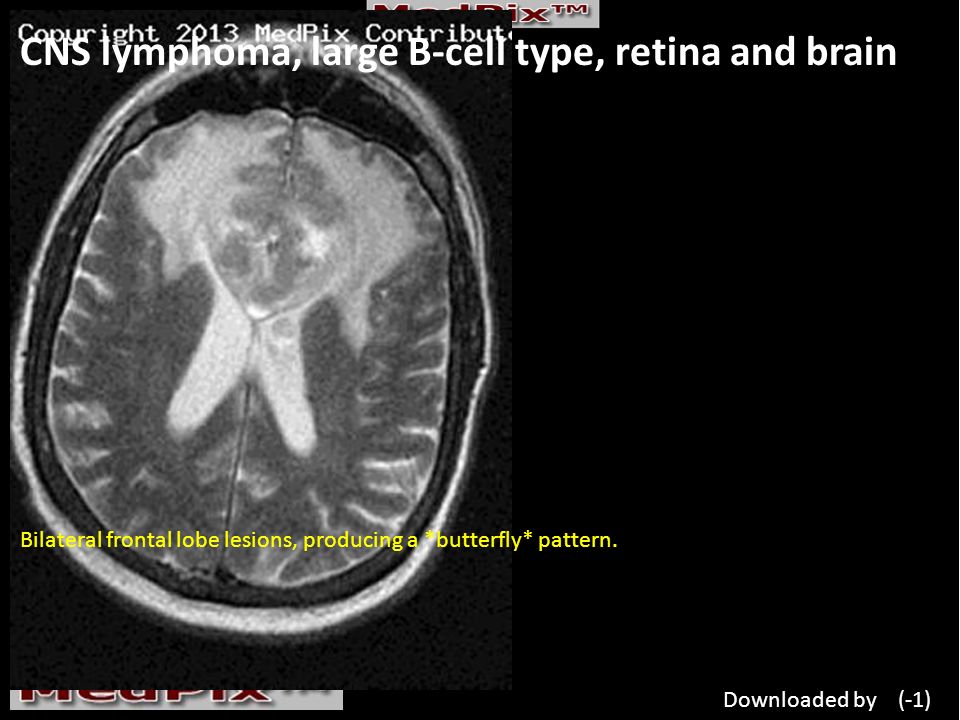 CNS lymphoma, large B-cell type, retina and brain Bilateral frontal lobe lesions, producing a *butterfly* pattern.