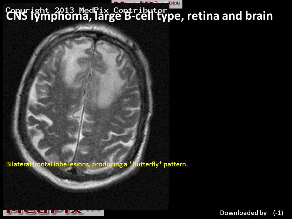 CNS lymphoma, large B-cell type, retina and brain Bilateral frontal lobe lesions, producing a *butterfly* pattern.