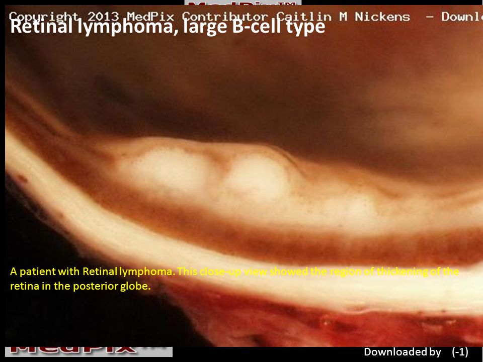 Retinal lymphoma, large B-cell type A patient with Retinal lymphoma.