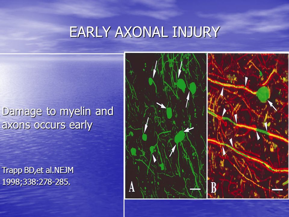 EARLY AXONAL INJURY Damage to myelin and axons occurs early Trapp BD,et al.NEJM 1998;338: