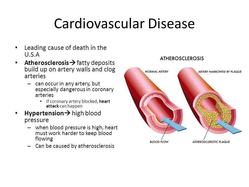 Cardiovascular Disease Leading cause of death in the U.S.A Atherosclerosis  fatty deposits build up on artery walls and clog arteries – can occur in any artery, but especially dangerous in coronary arteries If coronary artery blocked, heart attack can happen Hypertension  high blood pressure – when blood pressure is high, heart must work harder to keep blood flowing – Can be caused by atherosclerosis