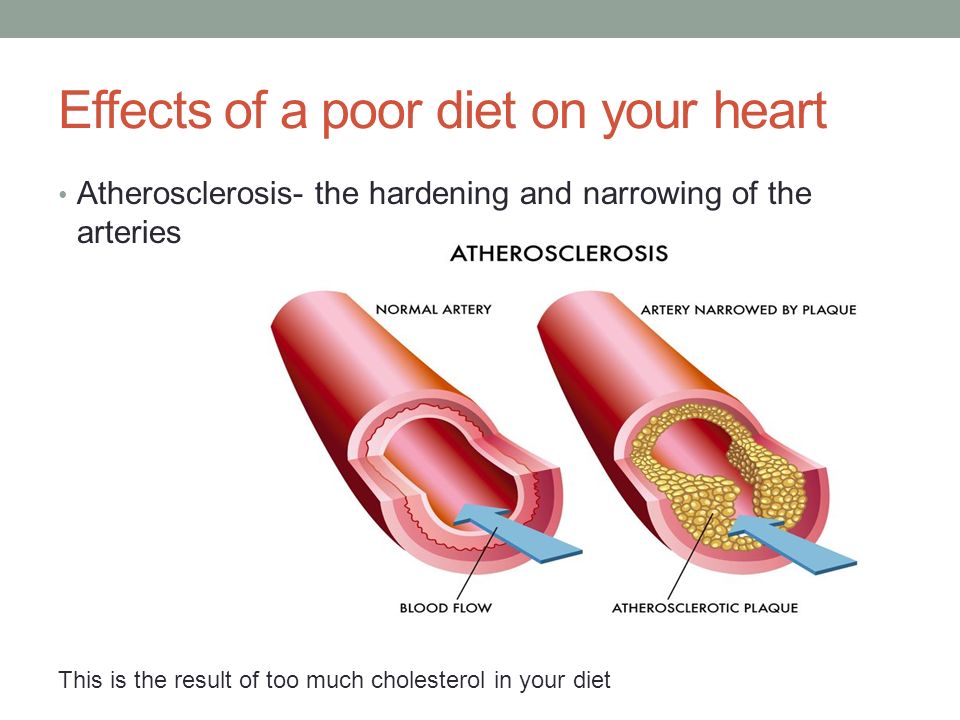 Effects of a poor diet on your heart Atherosclerosis- the hardening and narrowing of the arteries This is the result of too much cholesterol in your diet