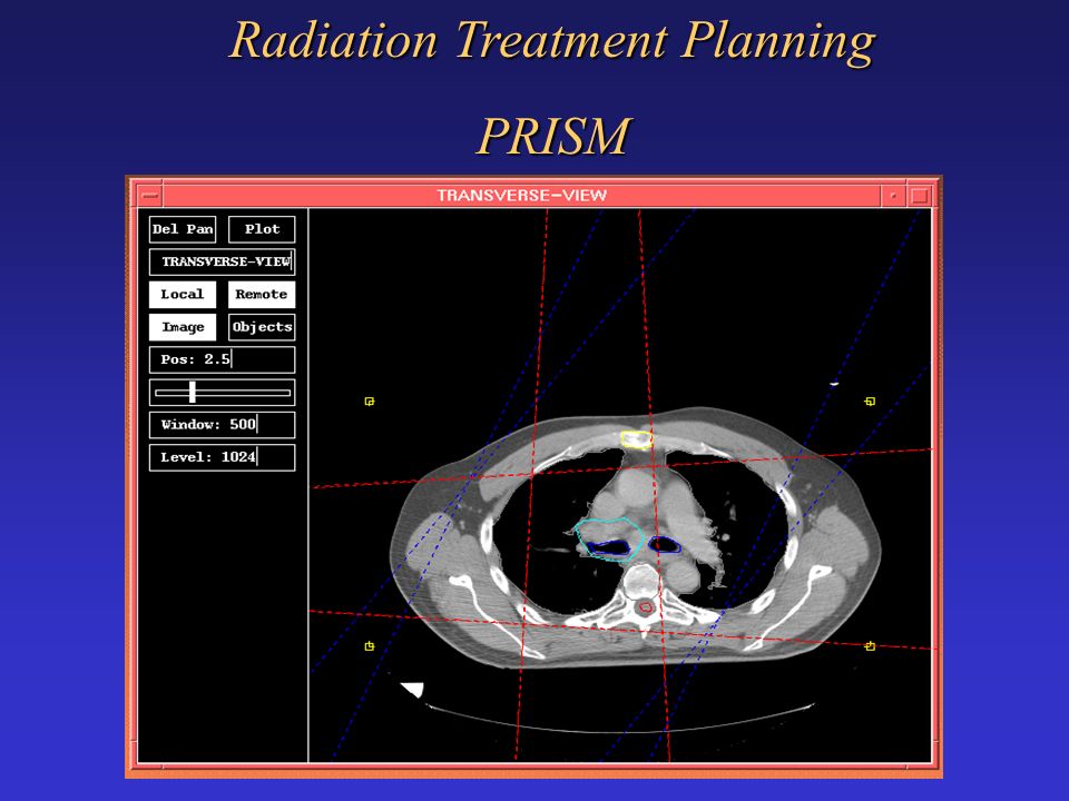 Radiation Treatment Planning PRISM