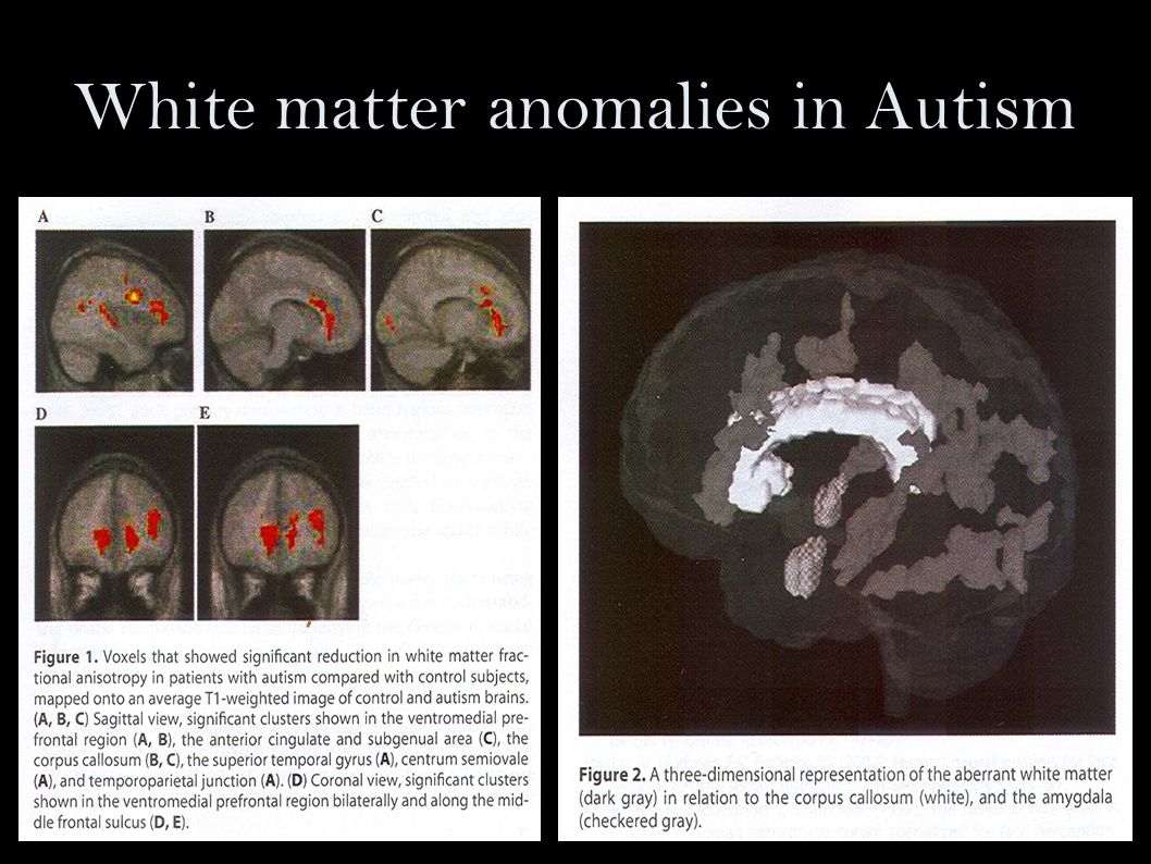 White matter anomalies in Autism