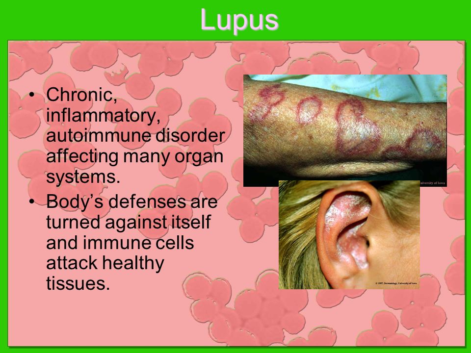Lupus Chronic, inflammatory, autoimmune disorder affecting many organ systems.