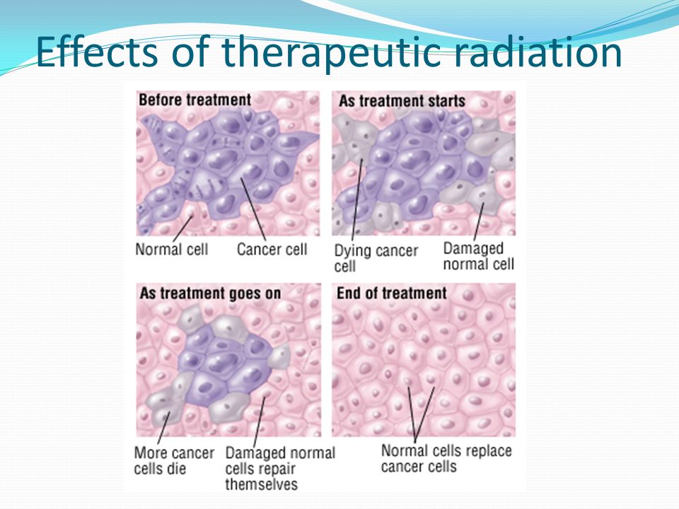 Effects of therapeutic radiation