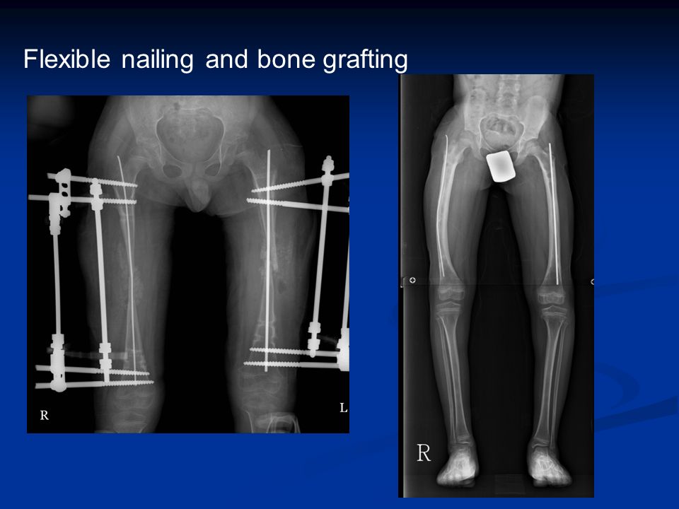 Flexible nailing and bone grafting