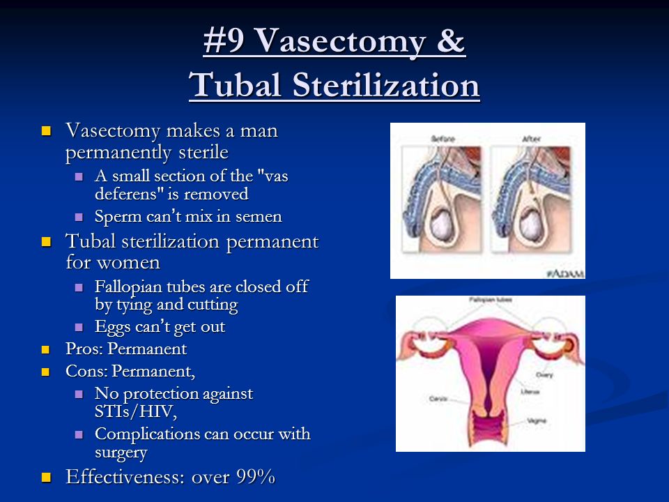 #9 Vasectomy & Tubal Sterilization Vasectomy makes a man permanently sterile Vasectomy makes a man permanently sterile A small section of the vas deferens is removed A small section of the vas deferens is removed Sperm can’t mix in semen Sperm can’t mix in semen Tubal sterilization permanent for women Tubal sterilization permanent for women Fallopian tubes are closed off by tying and cutting Fallopian tubes are closed off by tying and cutting Eggs can’t get out Eggs can’t get out Pros: Permanent Pros: Permanent Cons: Permanent, Cons: Permanent, No protection against STIs/HIV, No protection against STIs/HIV, Complications can occur with surgery Complications can occur with surgery Effectiveness: over 99% Effectiveness: over 99%