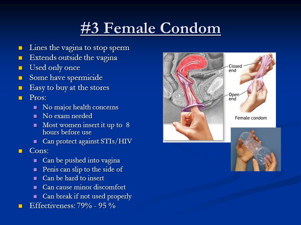 #3 Female Condom Lines the vagina to stop sperm Lines the vagina to stop sperm Extends outside the vagina Extends outside the vagina Used only once Used only once Some have spermicide Some have spermicide Easy to buy at the stores Easy to buy at the stores Pros: Pros: No major health concerns No major health concerns No exam needed No exam needed Most women insert it up to 8 hours before use Most women insert it up to 8 hours before use Can protect against STIs/HIV Can protect against STIs/HIV Cons: Cons: Can be pushed into vagina Can be pushed into vagina Penis can slip to the side of Penis can slip to the side of Can be hard to insert Can be hard to insert Can cause minor discomfort Can cause minor discomfort Can break if not used properly Can break if not used properly Effectiveness: 79% - 95 % Effectiveness: 79% - 95 %