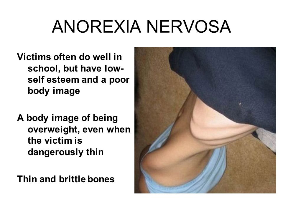 ANOREXIA NERVOSA Victims often do well in school, but have low- self esteem and a poor body image A body image of being overweight, even when the victim is dangerously thin Thin and brittle bones