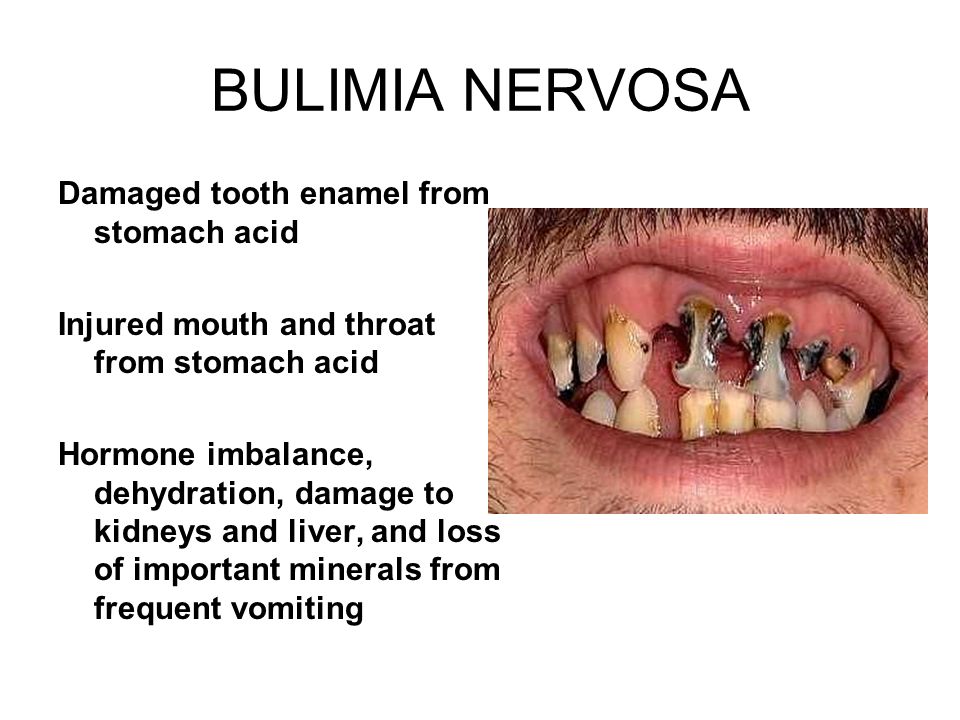 BULIMIA NERVOSA Damaged tooth enamel from stomach acid Injured mouth and throat from stomach acid Hormone imbalance, dehydration, damage to kidneys and liver, and loss of important minerals from frequent vomiting
