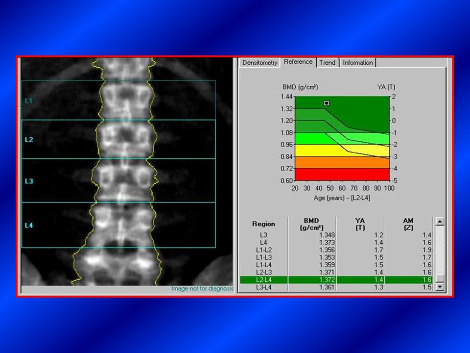 Денситометрия показатели. Остеоденситометрия остеопороз. Остеопороз ультразвуковая денситометрия. Денситометрия грудного отдела позвоночника. Система рентгеновской костной денситометрии.
