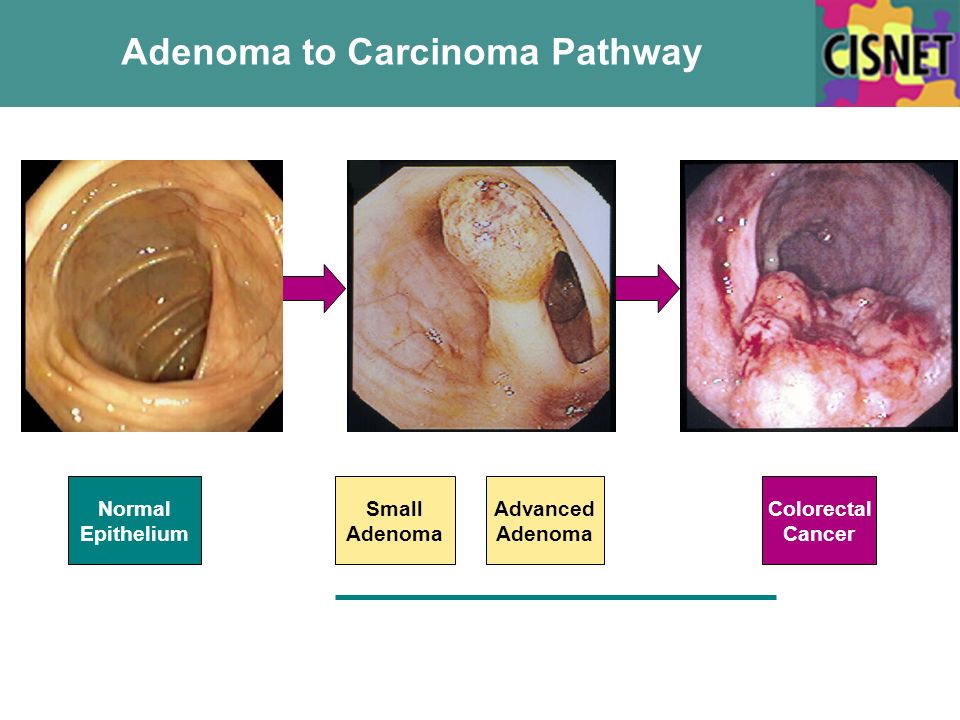 Adenoma to Carcinoma Pathway Normal Epithelium Small Adenoma Colorectal Cancer Advanced Adenoma