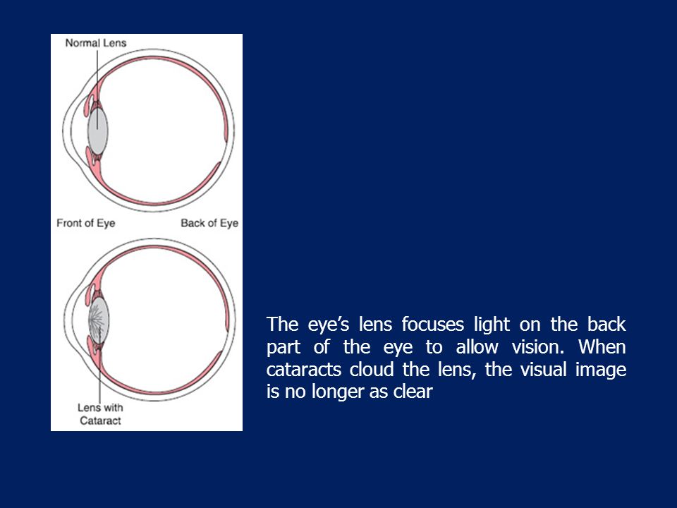 The eye’s lens focuses light on the back part of the eye to allow vision.