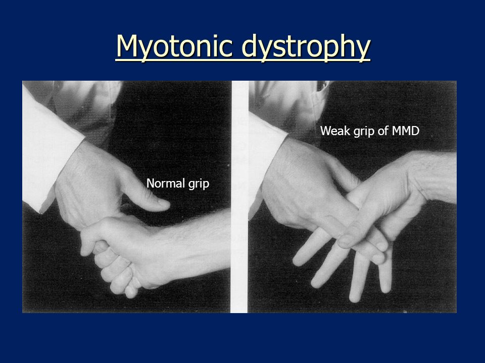 Myotonic dystrophy Normal grip Weak grip of MMD