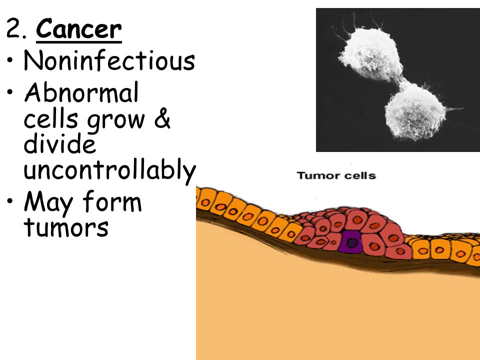 2. Cancer Noninfectious Abnormal cells grow & divide uncontrollably May form tumors