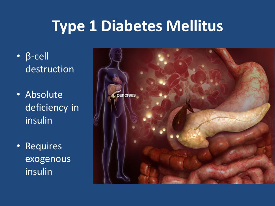 Type 1 Diabetes Mellitus β-cell destruction Absolute deficiency in insulin Requires exogenous insulin