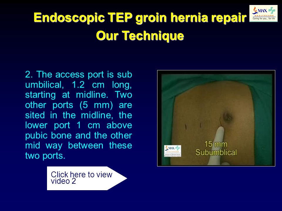 Endoscopic TEP groin hernia repair Our Technique 2.