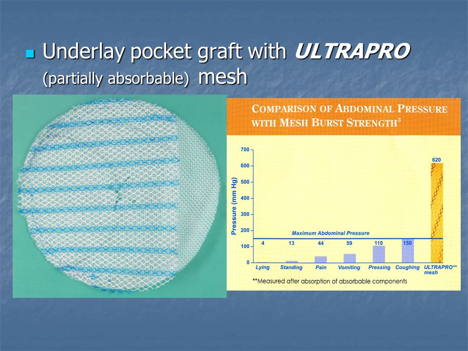 Underlay pocket graft with ULTRAPRO (partially absorbable) mesh Underlay pocket graft with ULTRAPRO (partially absorbable) mesh