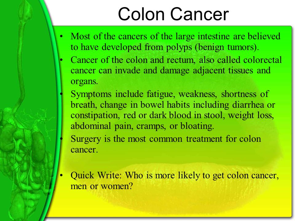 Colon Cancer Most of the cancers of the large intestine are believed to have developed from polyps (benign tumors).