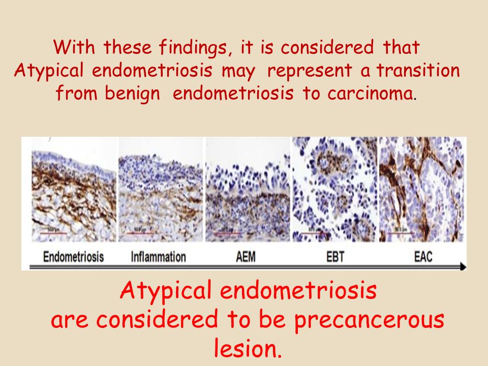 Atypical endometriosis are considered to be precancerous lesion.